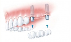Имплантация при отсутствии двух и более зубов